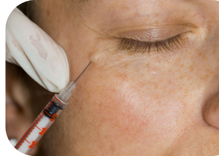 Botox (3) botox injectables