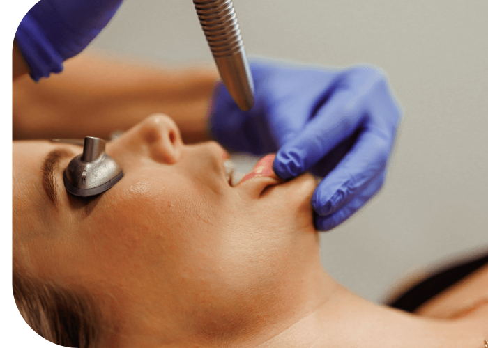 LipLase (2) lip laser treatments