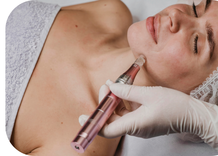 Microneedling microneedling near me