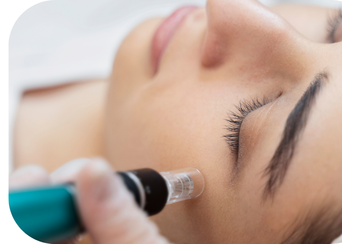 microneedling treatments