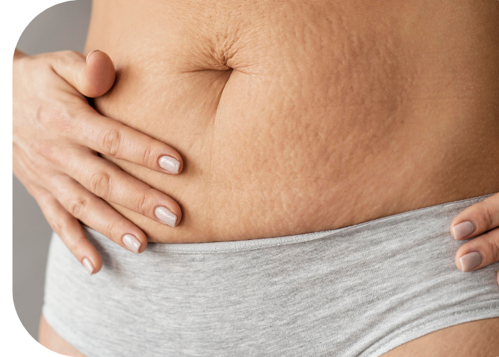 Stretch Mark Revision