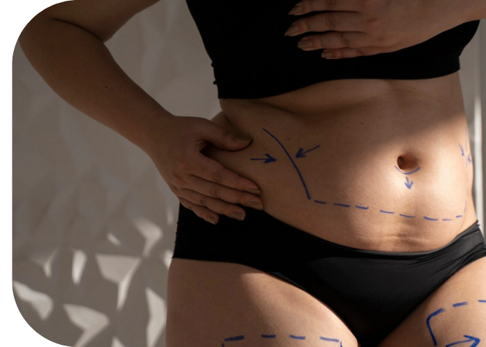 fotona tightsculpting